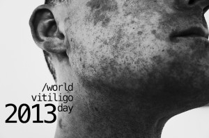 A vitiligo kezelése rendkívül fontos